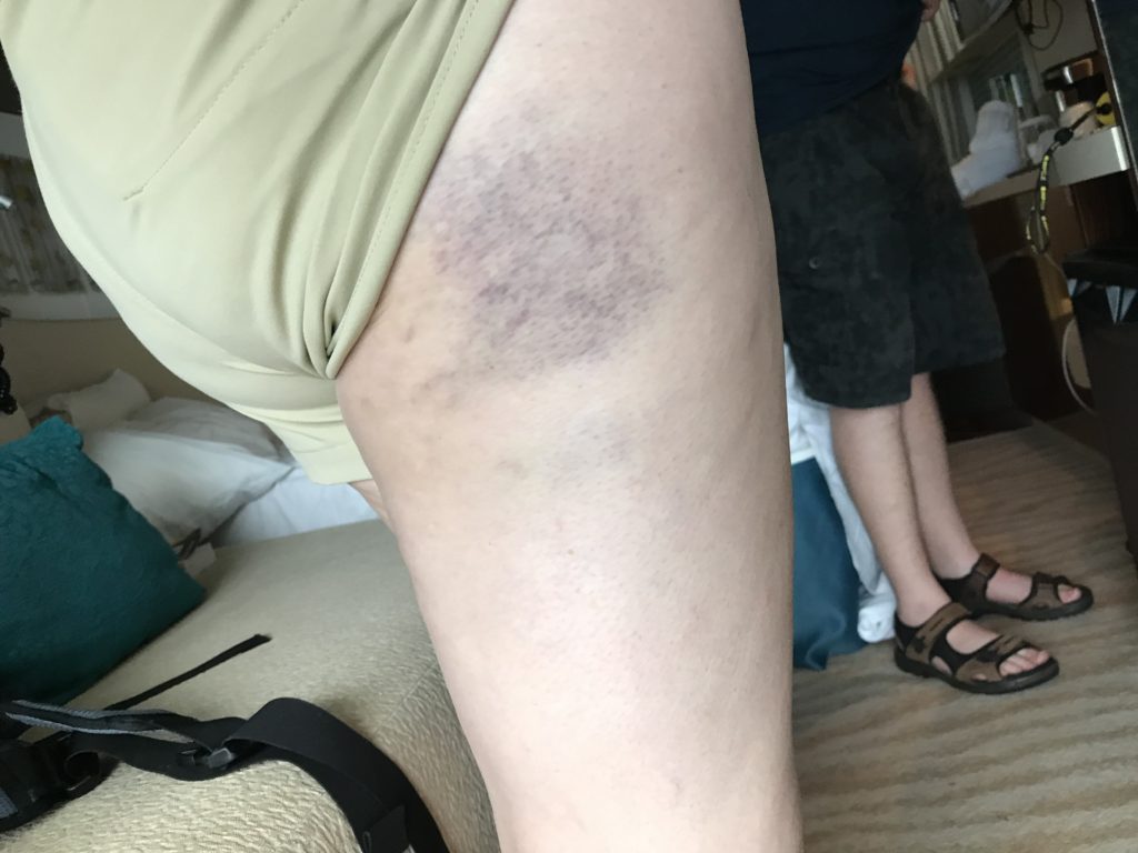 Bad bruise on leg